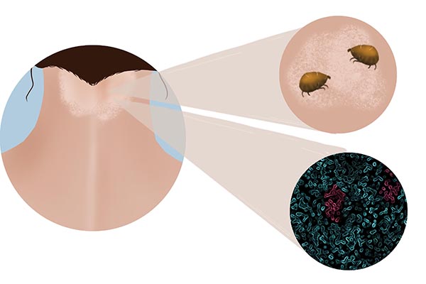 头皮上长红疙瘩脓包剃光头管用吗,头皮上长红疙瘩脓包涂什么药膏