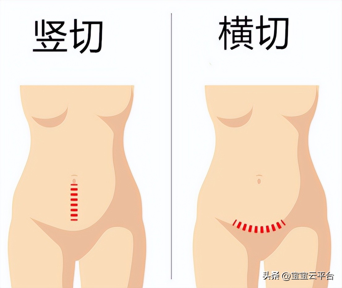 剖腹产疤痕两个半月了增生而且痒,剖腹产疤痕呈银色增生该抹什么药