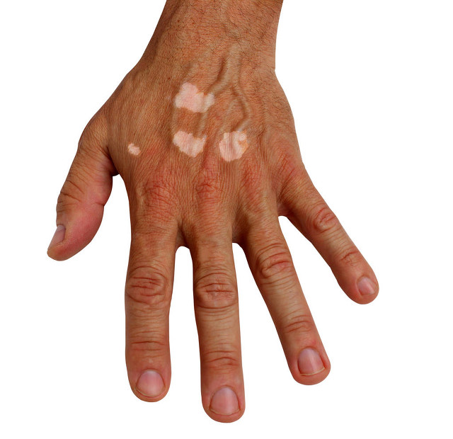 白癜风患者不要怕，了解以下4点问题，你的白癜风就离好不远了