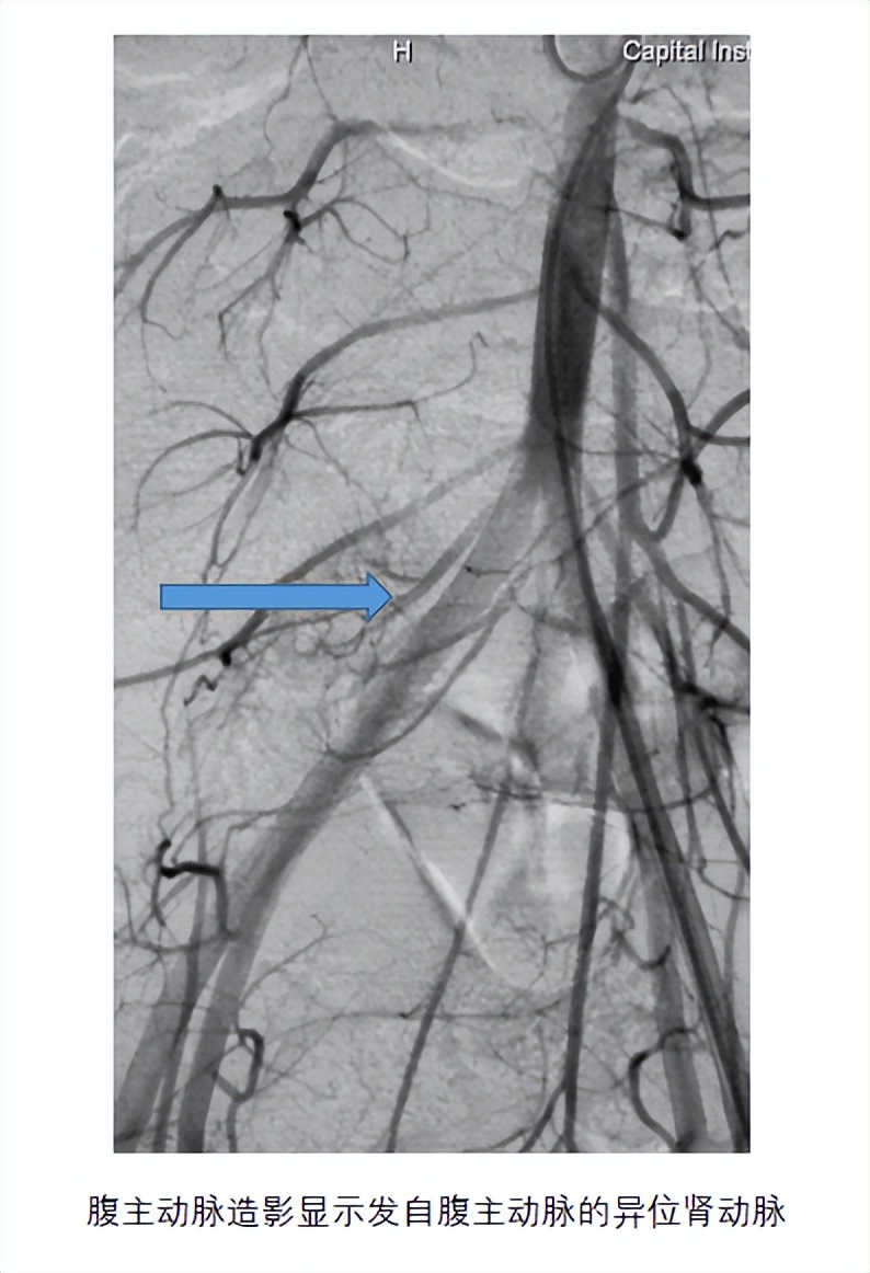 异位肾最佳治疗方法,异位肾要做手术吗