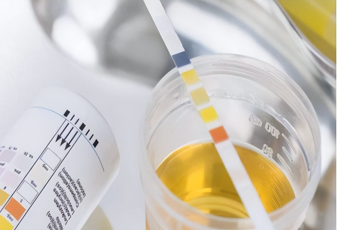 尿液柠檬黄是什么原因引起的,尿液黄泡沫多是什么原因