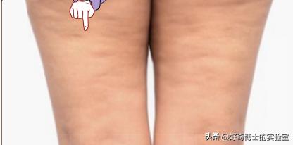 女生大腿外侧出现小条纹,为什么女生大腿上会有条纹