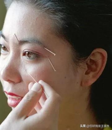 中医神奇的放血术，一针治疗偏头痛