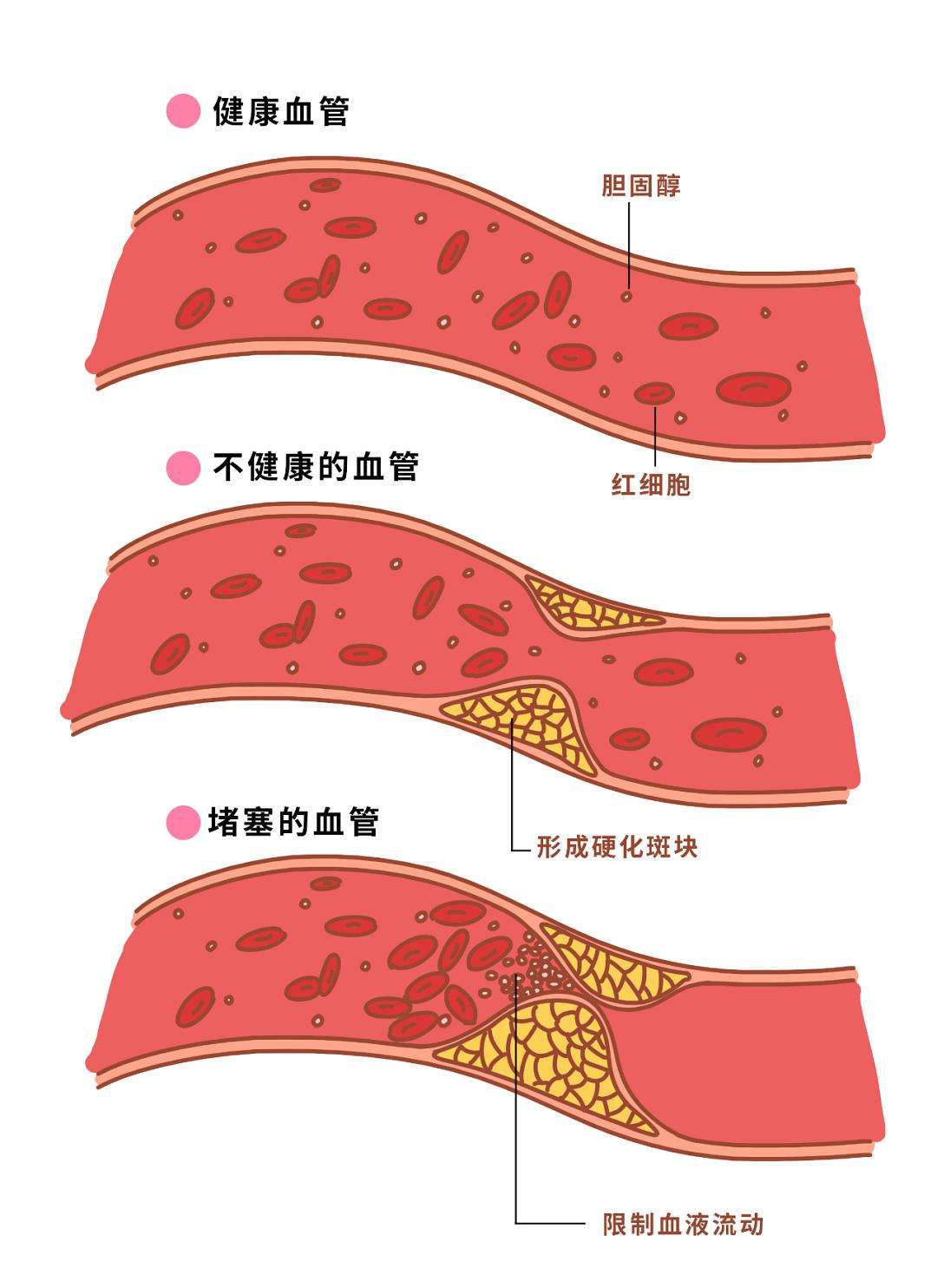 胆固醇高要吃药降下来吗？