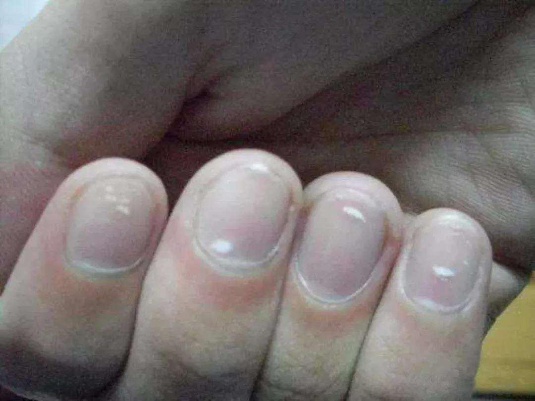 指甲出现异常是肝上出问题了吗,口苦口臭指甲竖纹是肝的问题吗