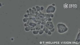 肝癌nk细胞免疫治疗,nk细胞治疗肿瘤最好的专家