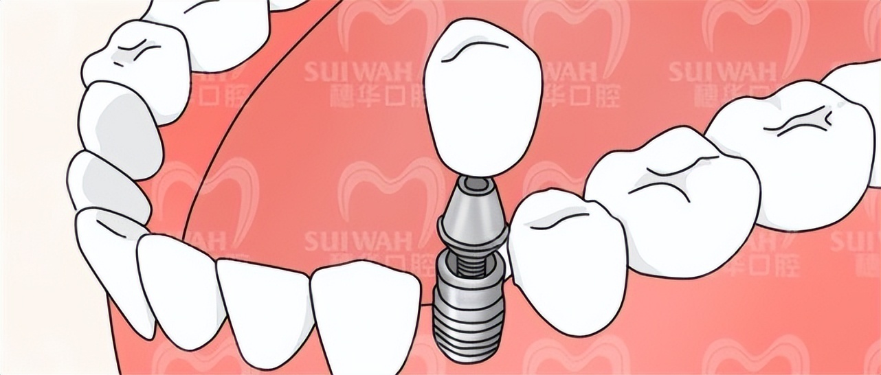 疫情期间，牙疼、牙套丢了怎么办？暨南大学穗华口腔专家在线支招