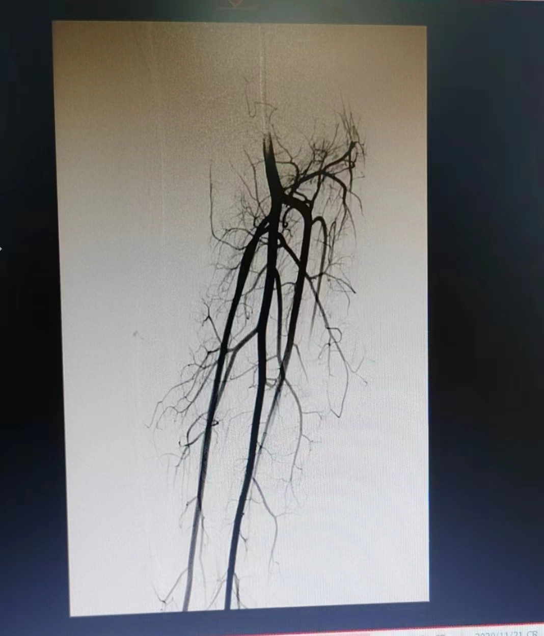 胎记竟然是血管罕见病，微创介入帮女童按下疾病“暂停键”