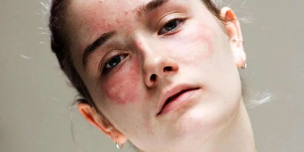 春敏脸上泛红发痒原因,春敏肌屏障修复