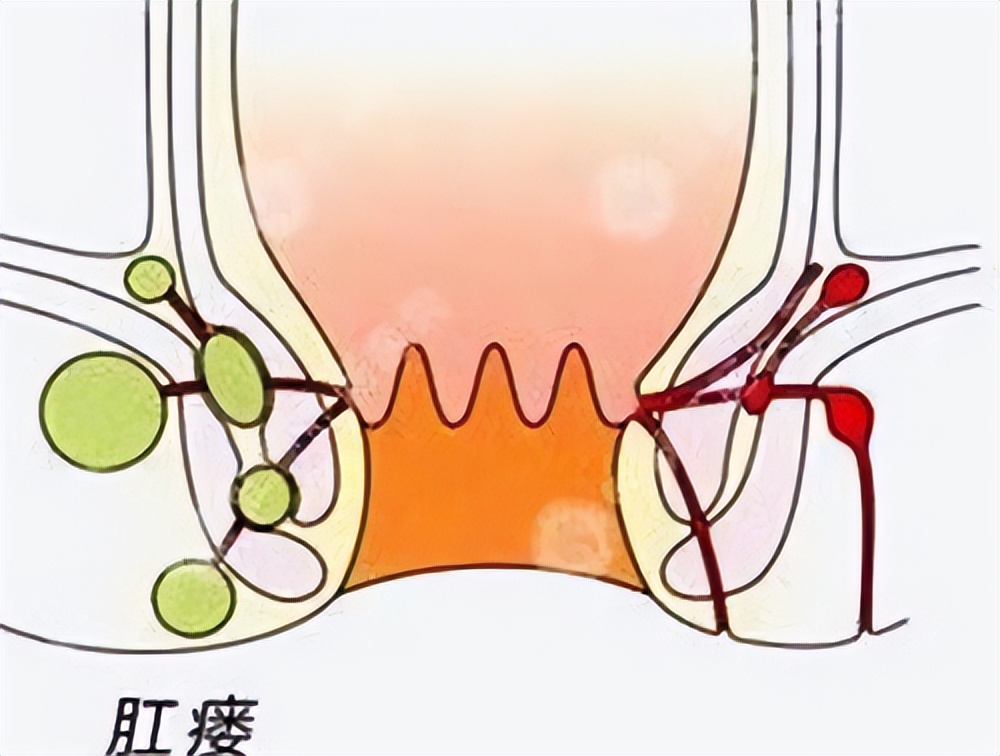 22岁女子肛瘘,高位复杂肛瘘患者自述