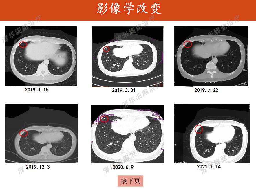 肉瘤领域的免疫疗法新策略,肉瘤免疫治疗的费用