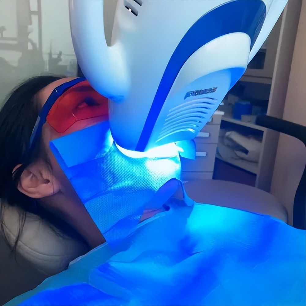 牙齿冷光美白是什么,牙齿冷光美白有副作用么