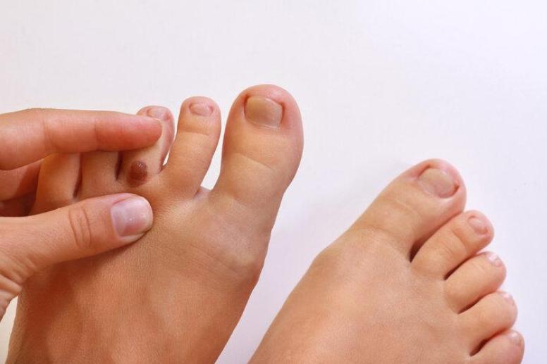 警惕这些痣可能会成瘤,哪些地方有痣代表得癌症了