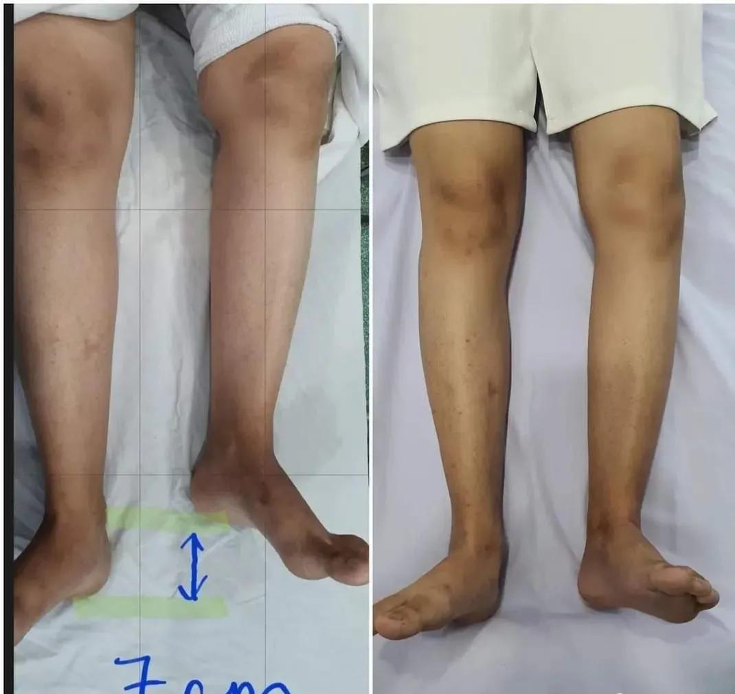 30分钟站桩第10天(腰疼中)