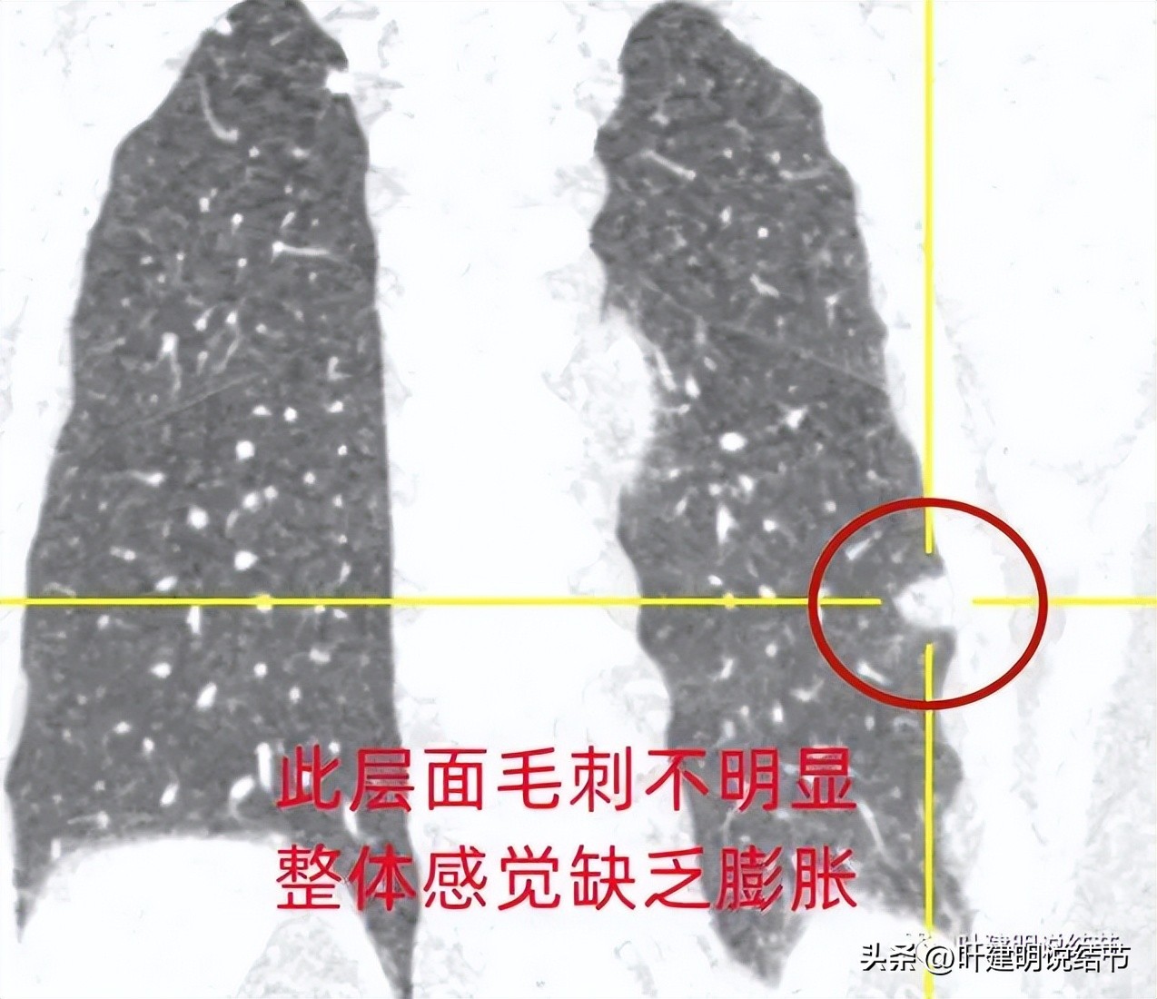 肺结节实性为什么建议抗炎治疗,肺上实性结节抗炎后变成空洞