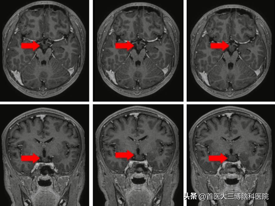 三博脑科医院脊髓外肿瘤手术,三博医院垂体瘤专家