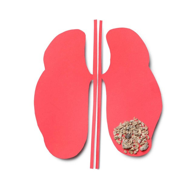 女的肾结石有什么表现,肾结石x线表现是什么