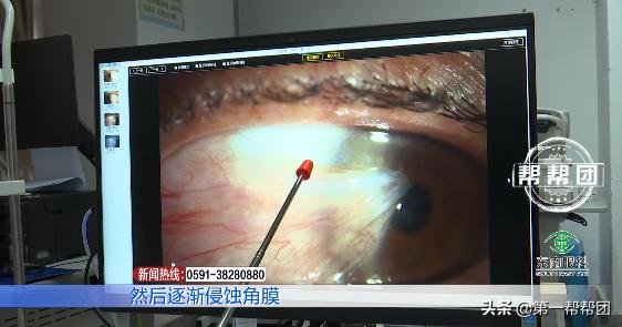 35岁男子视物模糊查出肝癌晚期,眼睛有翼状胬肉属于白内障吗