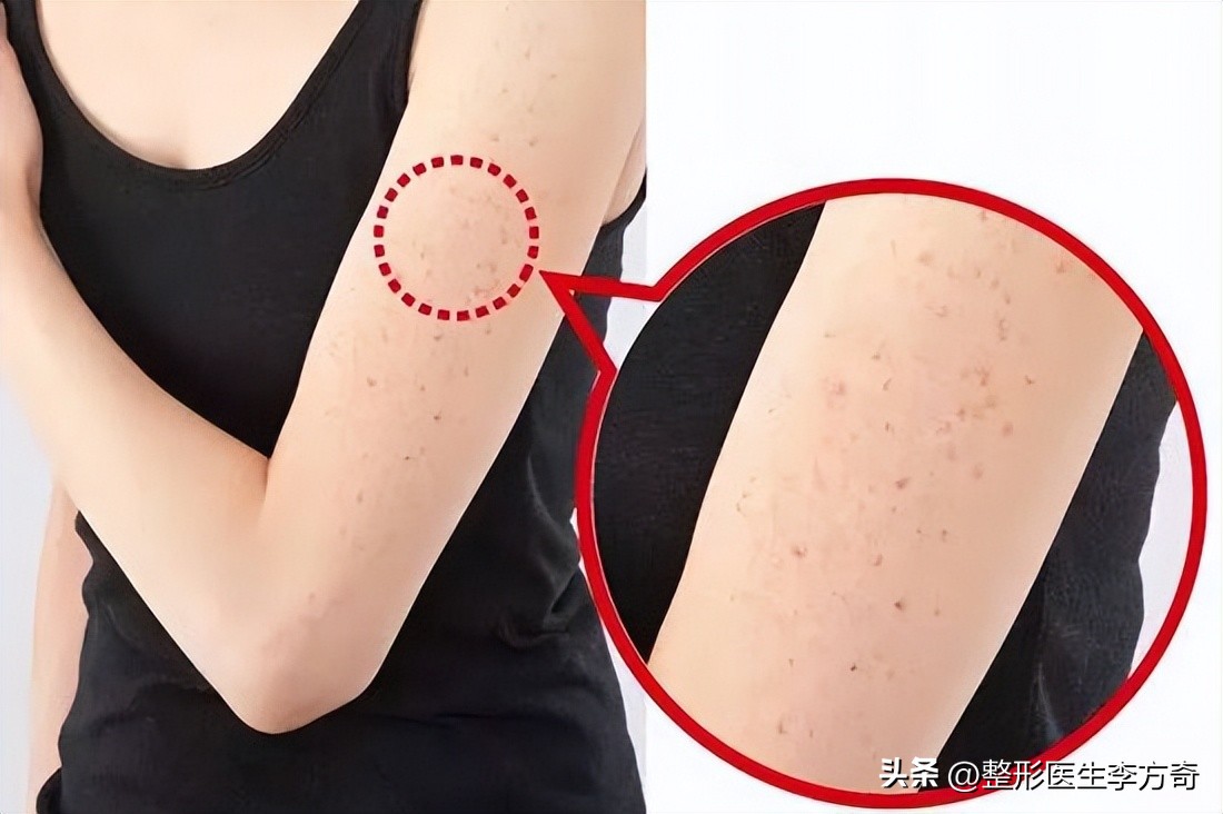 鸡皮疙瘩毛囊角化症怎么才能治好,毛囊角化鸡皮肤激光可以解决吗