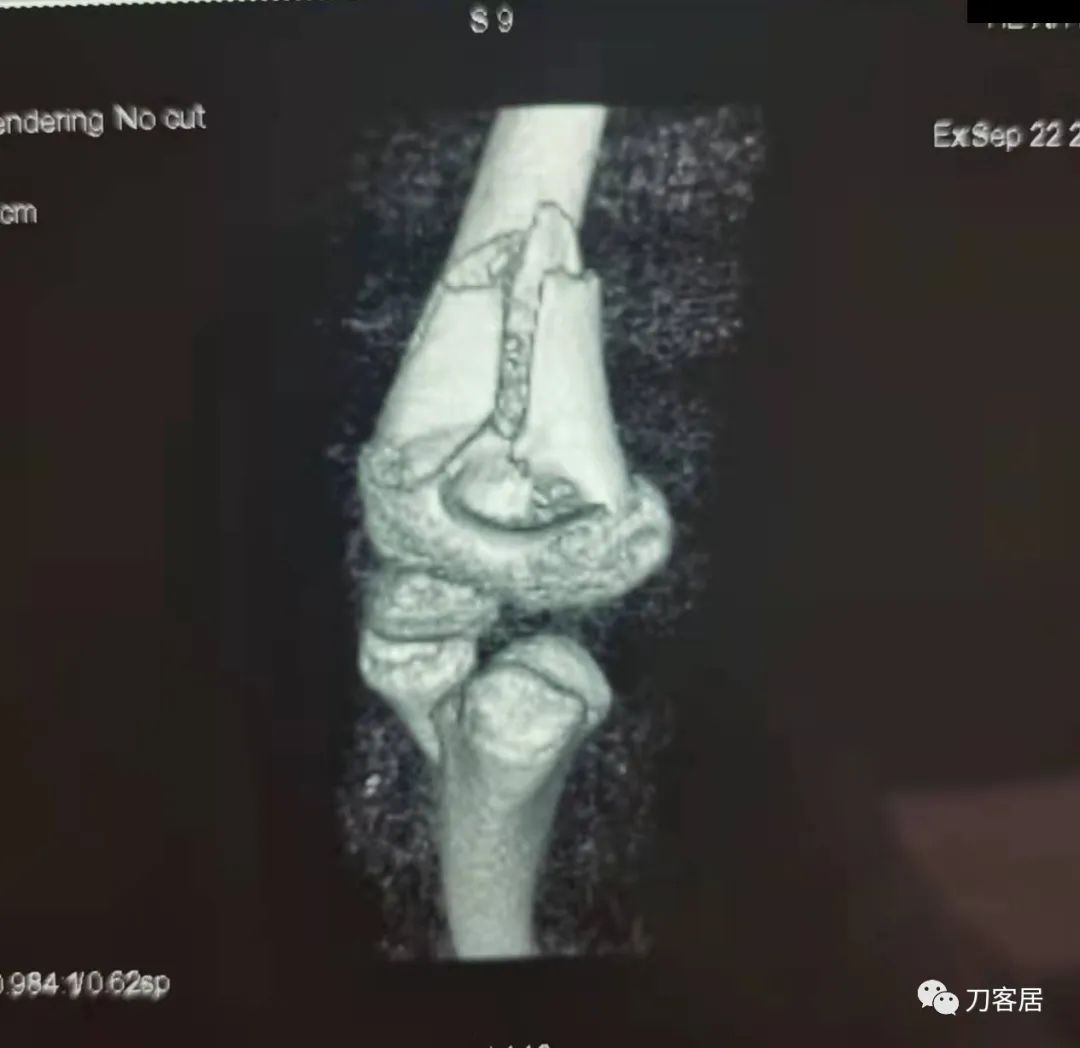 孩子胳膊摔伤肿了不能弯曲一直疼,9岁男孩摔倒手臂痛怎么办