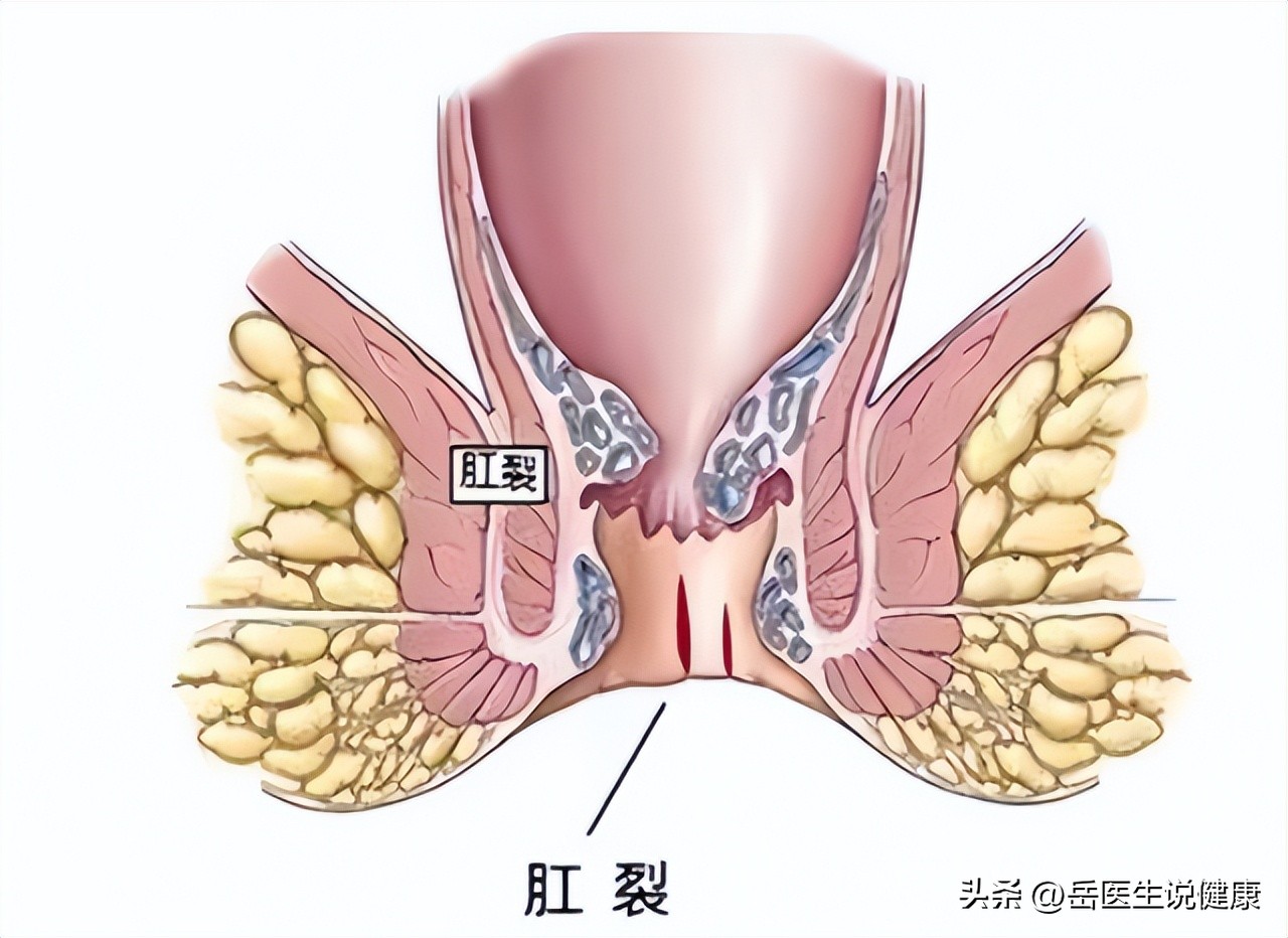 女性肛裂的原因和治疗方法,为什么越来越多的女性肛裂