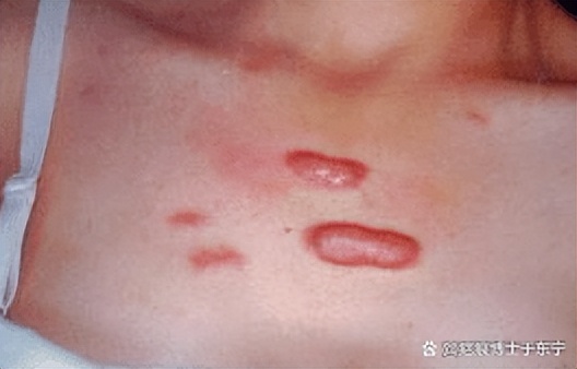 打了疤痕软化针后血管明显,打了祛疤软化针之后胸胀正常吗