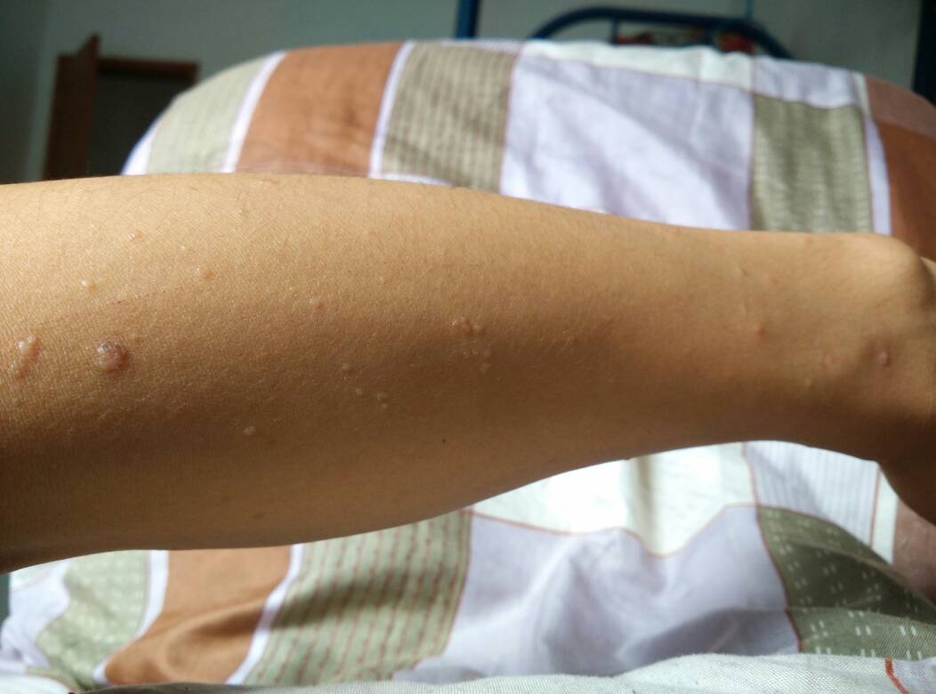 在“深入了解”前，如何判断对象有没有性病？医生：这几点要记住