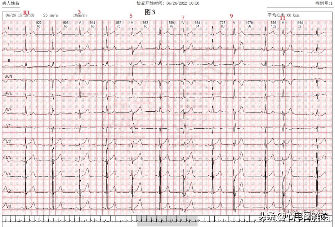 可见室性融合波是什么意思,室性融合波什么意思