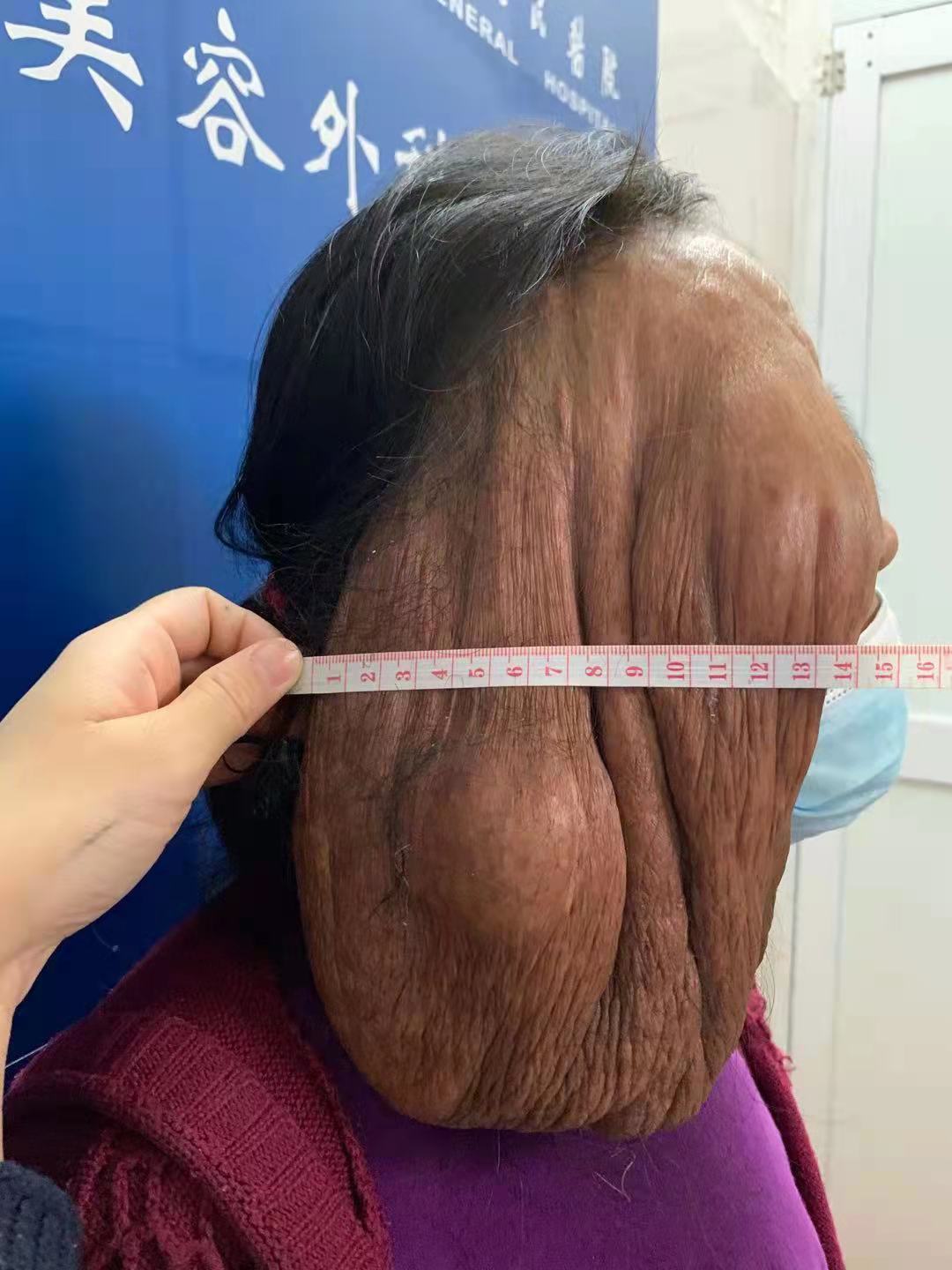 “小米粒”51年后变“大肉帘”！武汉大学人民医院整形专家摘除罕见面部巨大神经纤维瘤