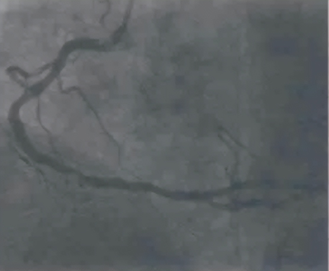 急诊PCI指南,急诊pci治疗费用