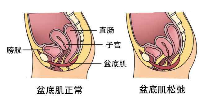 散步时*体下**掉出个肉球？压力压垮的不止精神，还有盆底！