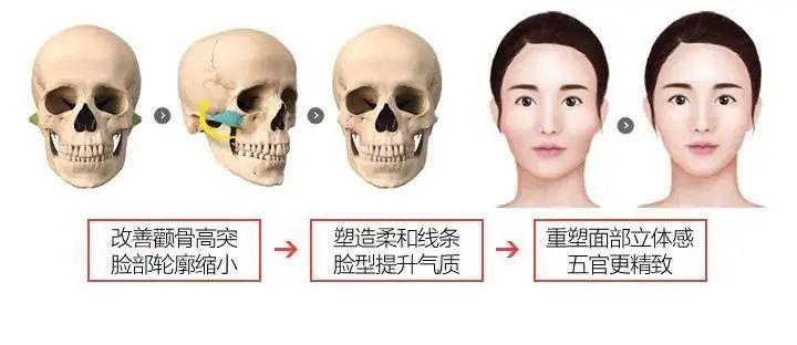颧骨太突是怎么回事,脸型颧骨大该怎么办