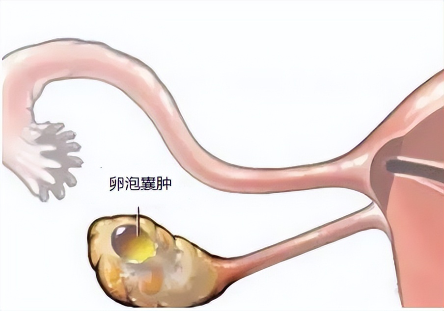 卵巢囊肿超声穿刺手术怎么做的,黄体囊肿与卵巢囊肿的超声区别