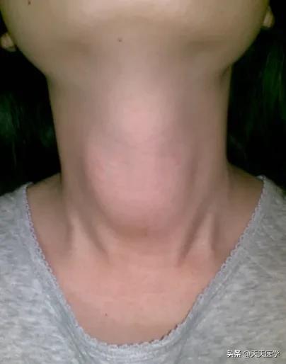 亚急性甲状腺炎的病因、诊断及治疗方法