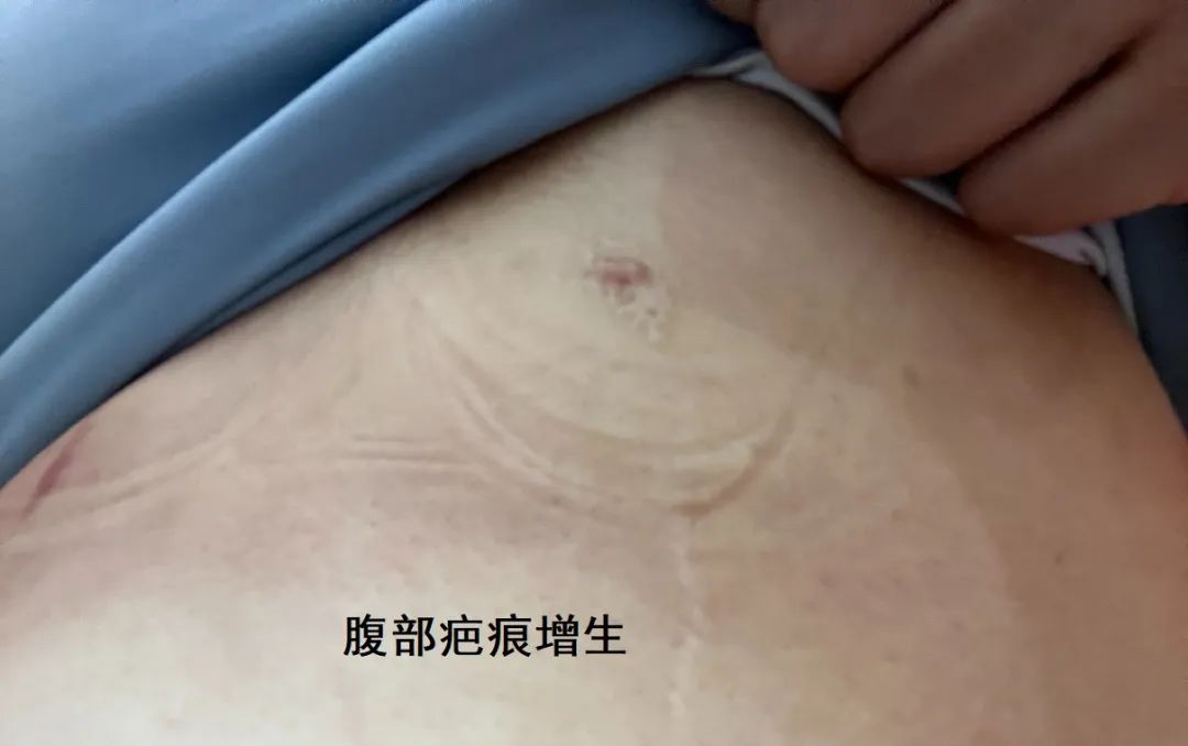 女子去抽脂手术后脸上溃烂,厦门华美整形医院抽脂