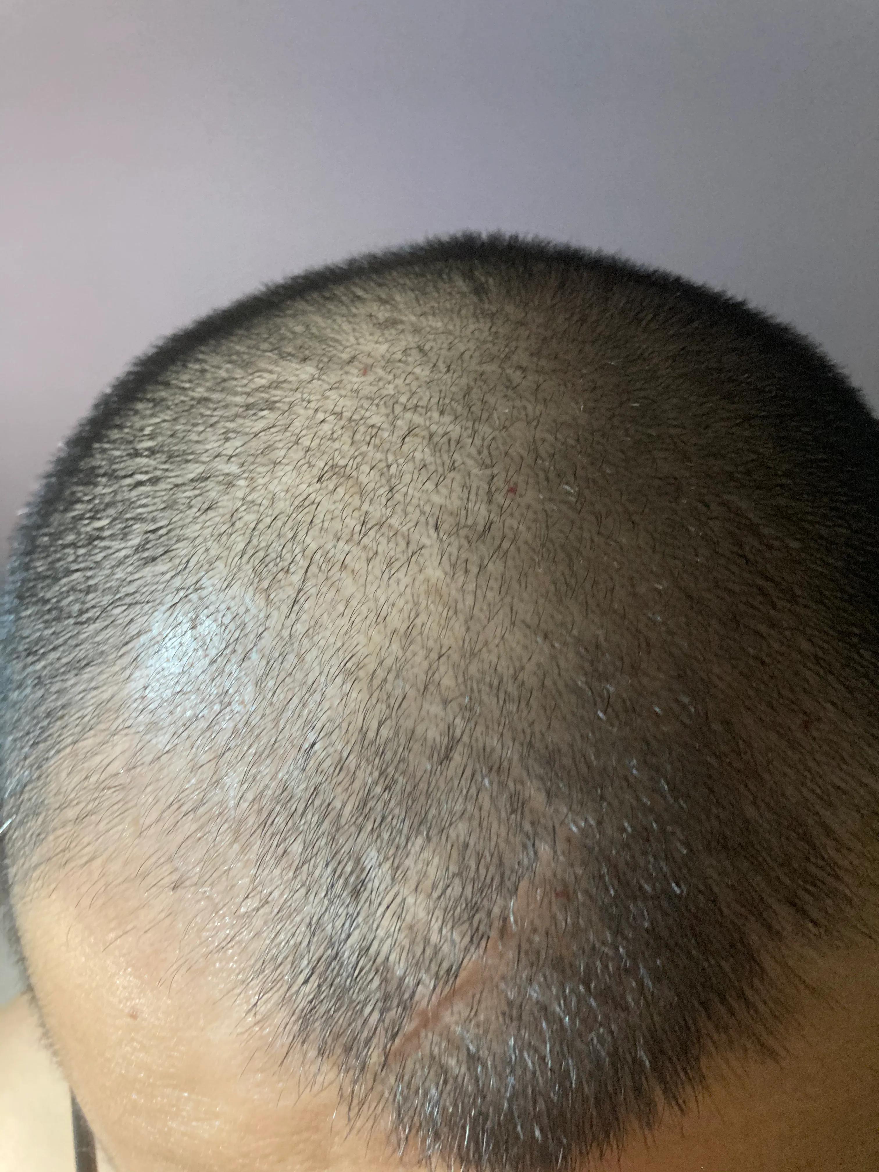 都说生姜能生发到底怎么用最合理,生姜生发的真实记录