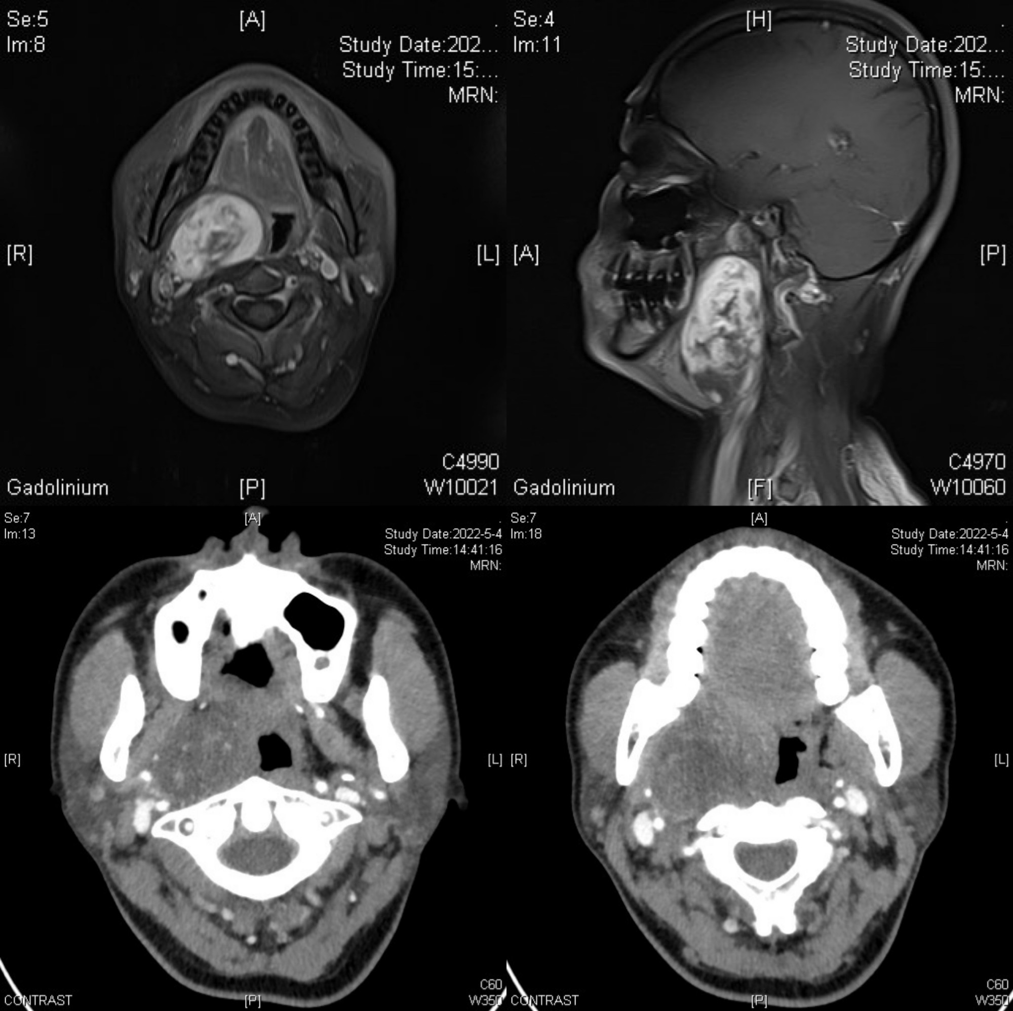 微创口腔颌面肿瘤,口腔颌面切除