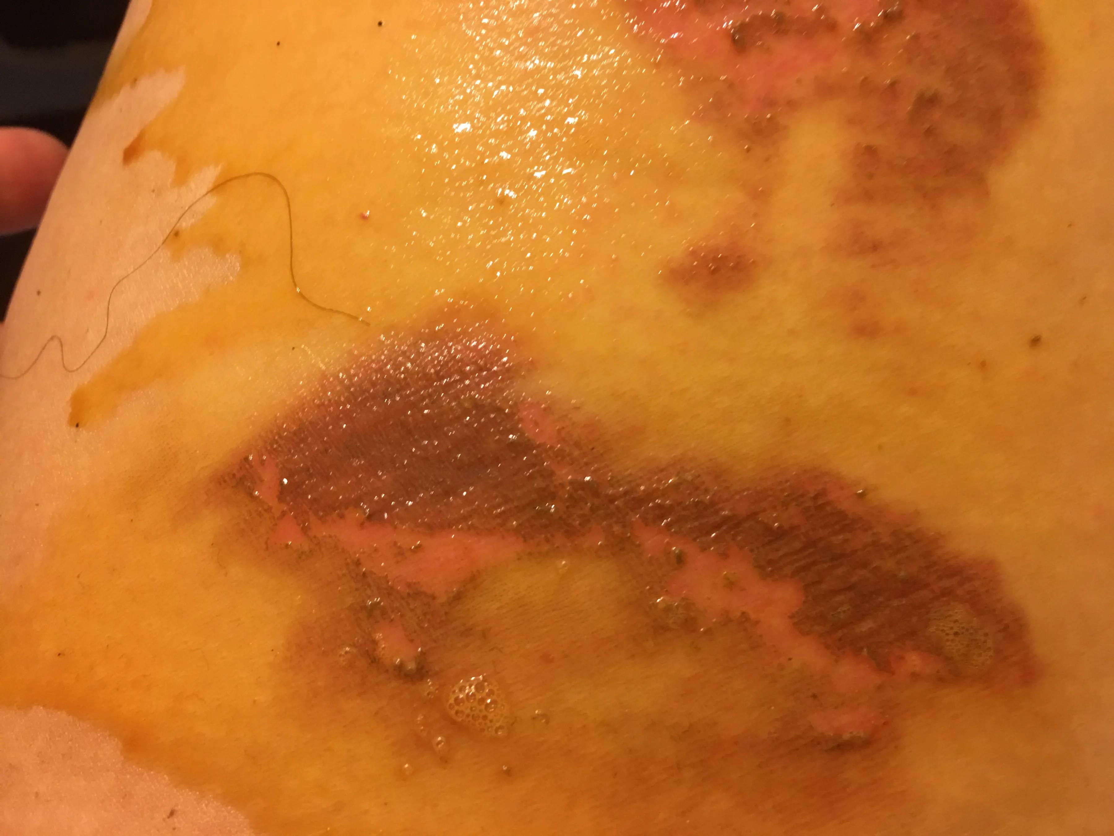 烫伤后续治疗费用怎么赔,烫伤的处理以及案例分析