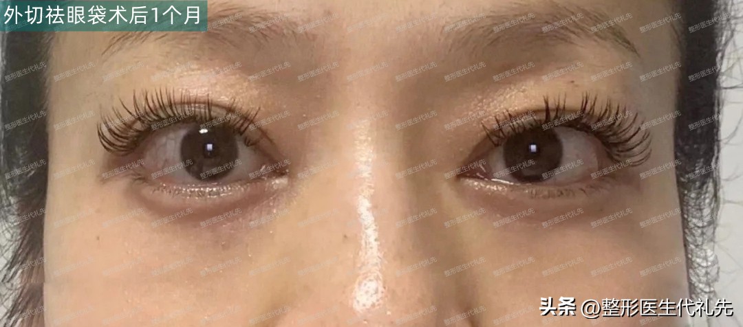 眼袋有明显的脂肪,眼袋脂肪去了显年轻