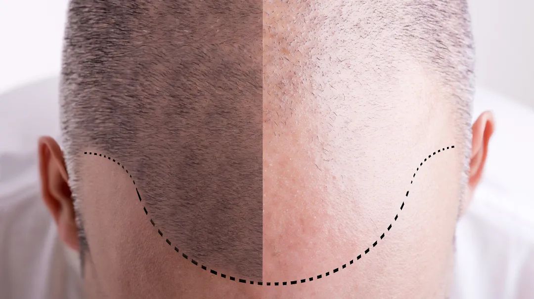 治疗脱发的口服药有什么副作用,美国治疗脱发最新科技