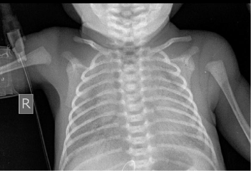 刚出生的小孩呼吸困难是怎么回事,小孩刚刚出生呼吸急促