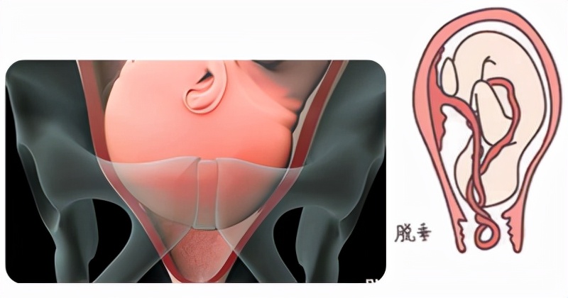 孕妈妈怎么判断胎位是正的,胎儿屁股在右侧是什么胎位