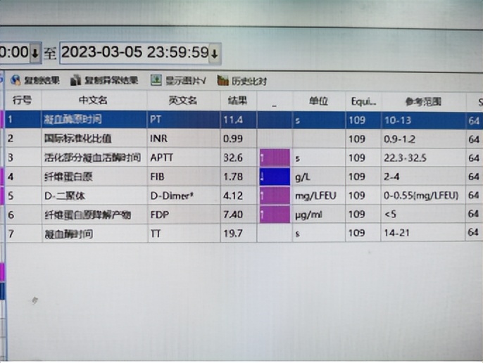 下肢肌间静脉畸形治疗案例,臀部静脉畸形怎么治疗比较好