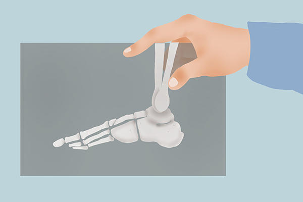 更年期足后跟痛是什么病怎样治疗,女性更年期容易出现哪些不适症状