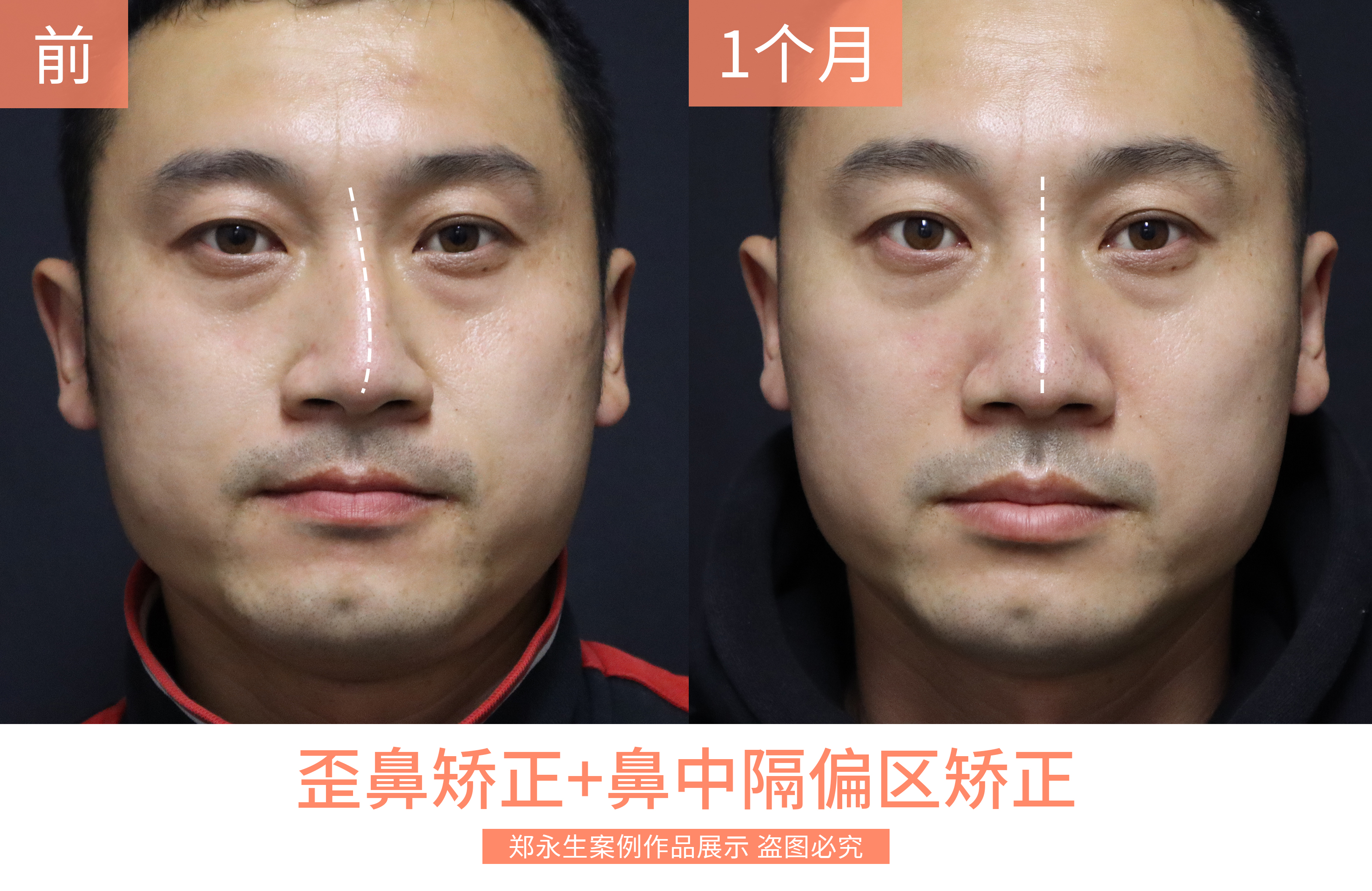 北京八大处整形医院歪鼻矫正,北京同仁医院鼻科知名专家排名