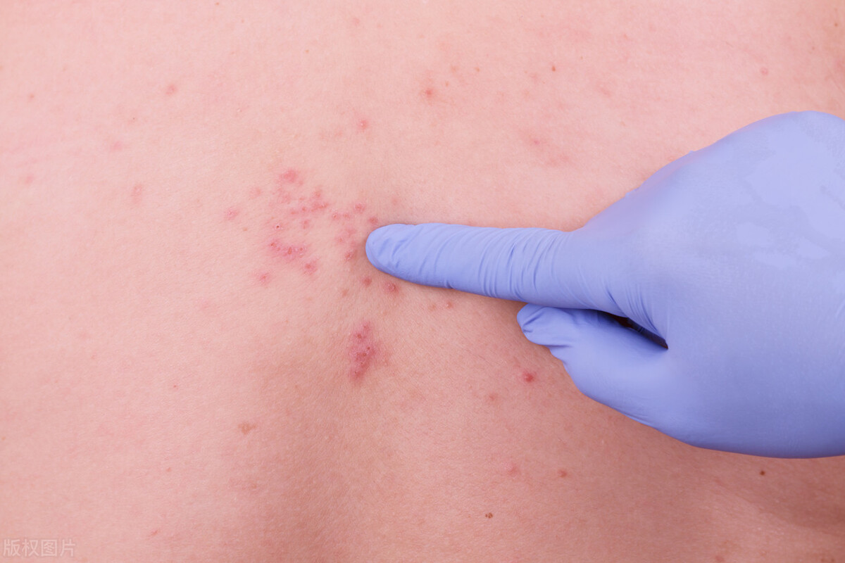 有一种疼痛就是带状疱疹的痛,有一种剧痛叫带状疱疹得了怎么治