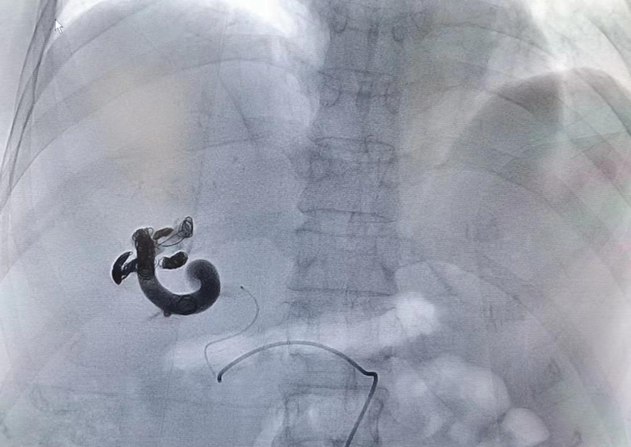 南昌大学二附院消化内科成功运用弹簧圈联合组织胶栓塞技术治疗一例高难度肝动脉-门静脉瘘患者
