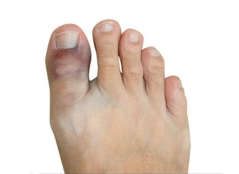 脚趾碰了一下怎么判断有没有骨折,脚趾扭伤怎么判断有没有伤到骨头