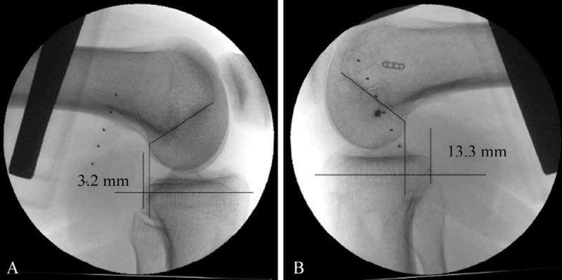 膝关节前交叉韧带损伤怎么治,十字交叉韧带损伤如何解决
