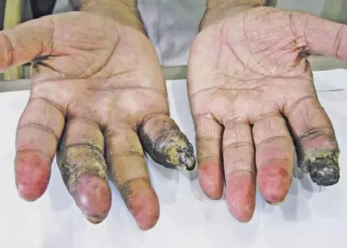 男子高烧40度掉皮,44岁男子发烧不退